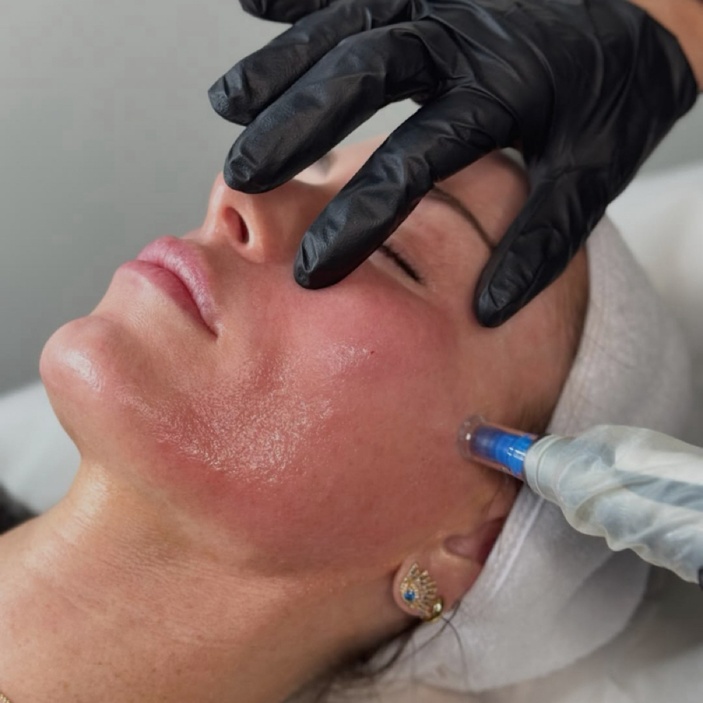Microneedling at Fae Esthetics in Raleigh, NC