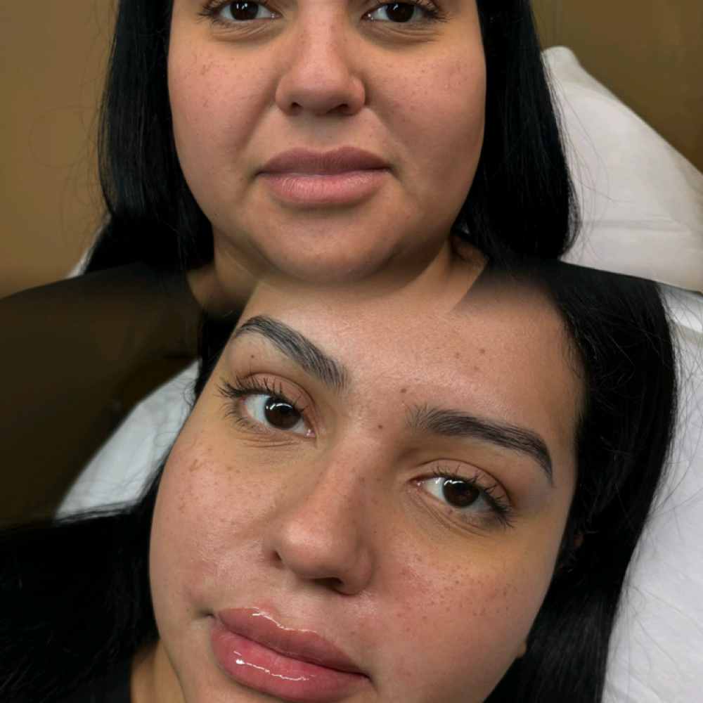 Smile Lines at Eluxy Aesthetics in Arlington, TX