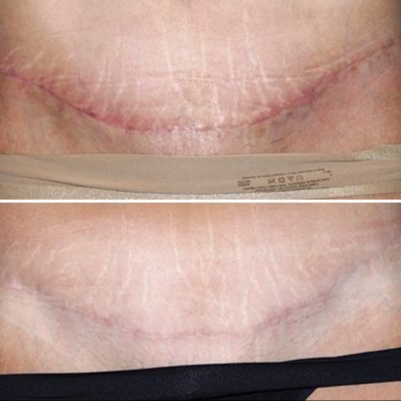 180 Tummy Tuck Surgical Scars at Cosmetic Studio 54 in Los Angeles, CA