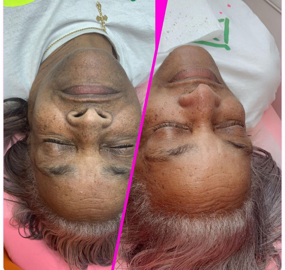 Hydration Facial