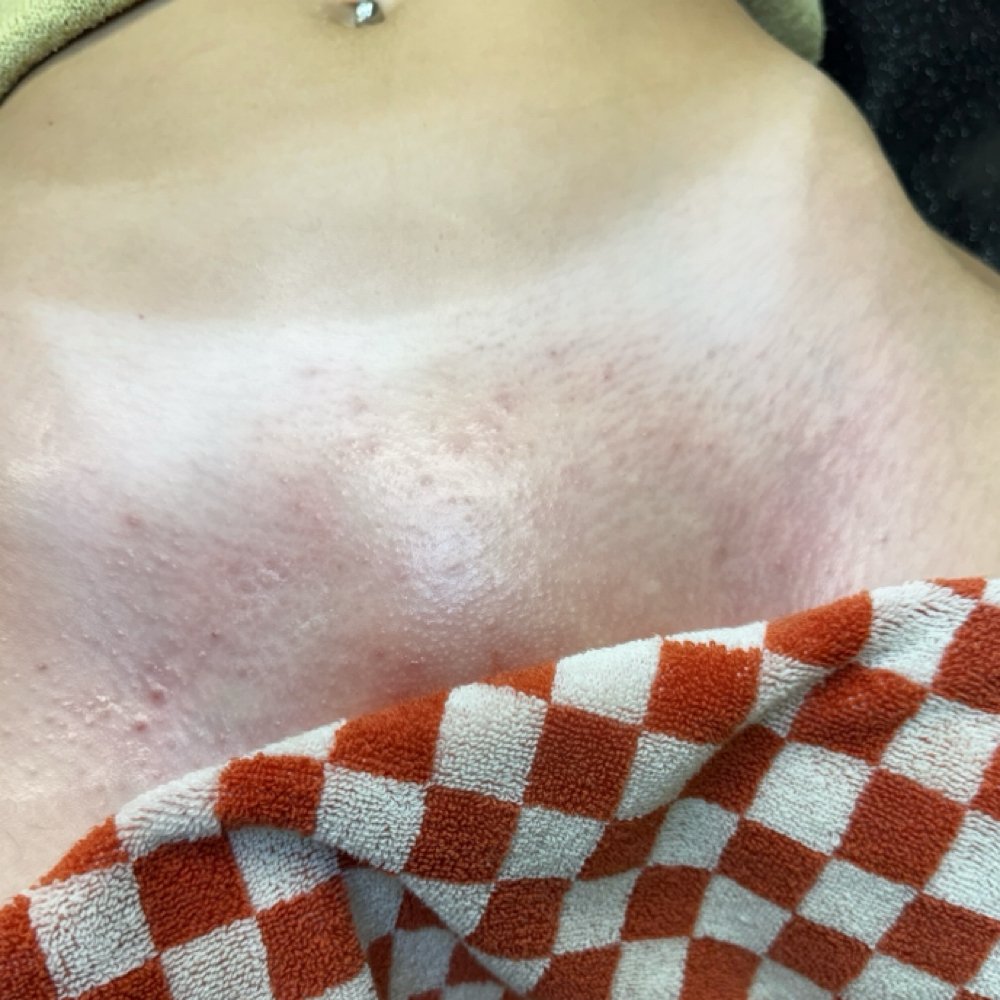 Ingrown Intervention Vajacial at The Cosmetic Ardis in Goldsboro, NC