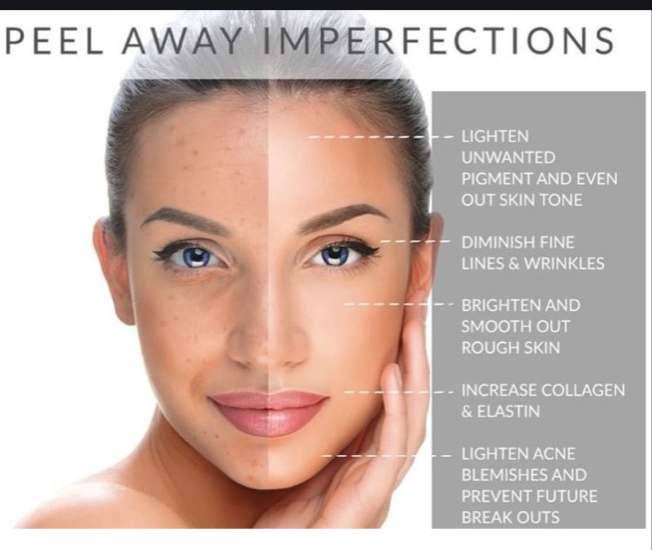Chemical Peel