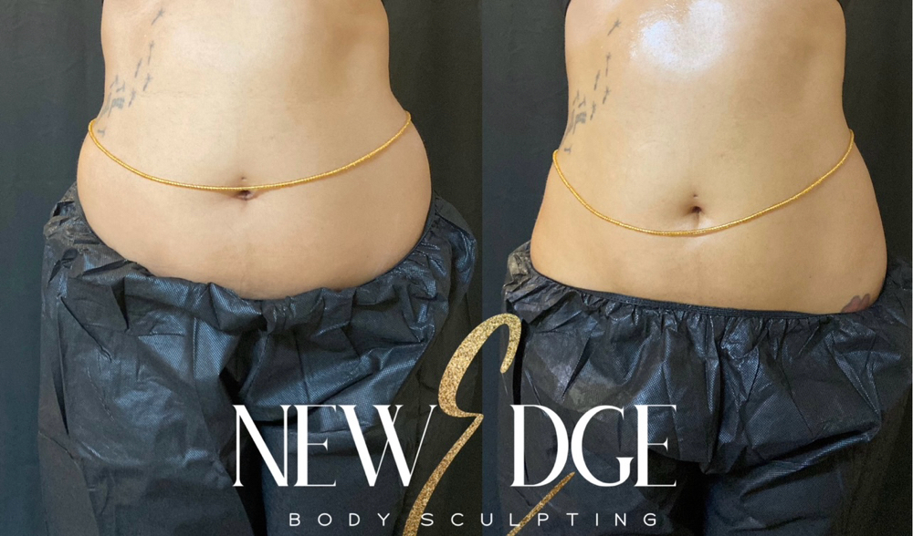 Laser Lipo x Cavitation