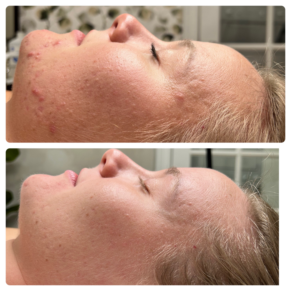 New Client Consult. +Acne Facial