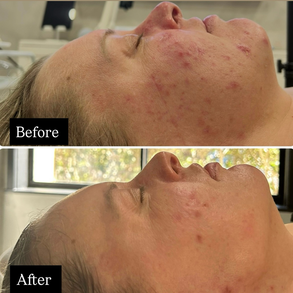 New Client Consult. +Acne Facial at Skincare by Carmen Dindo in Sarasota, FL