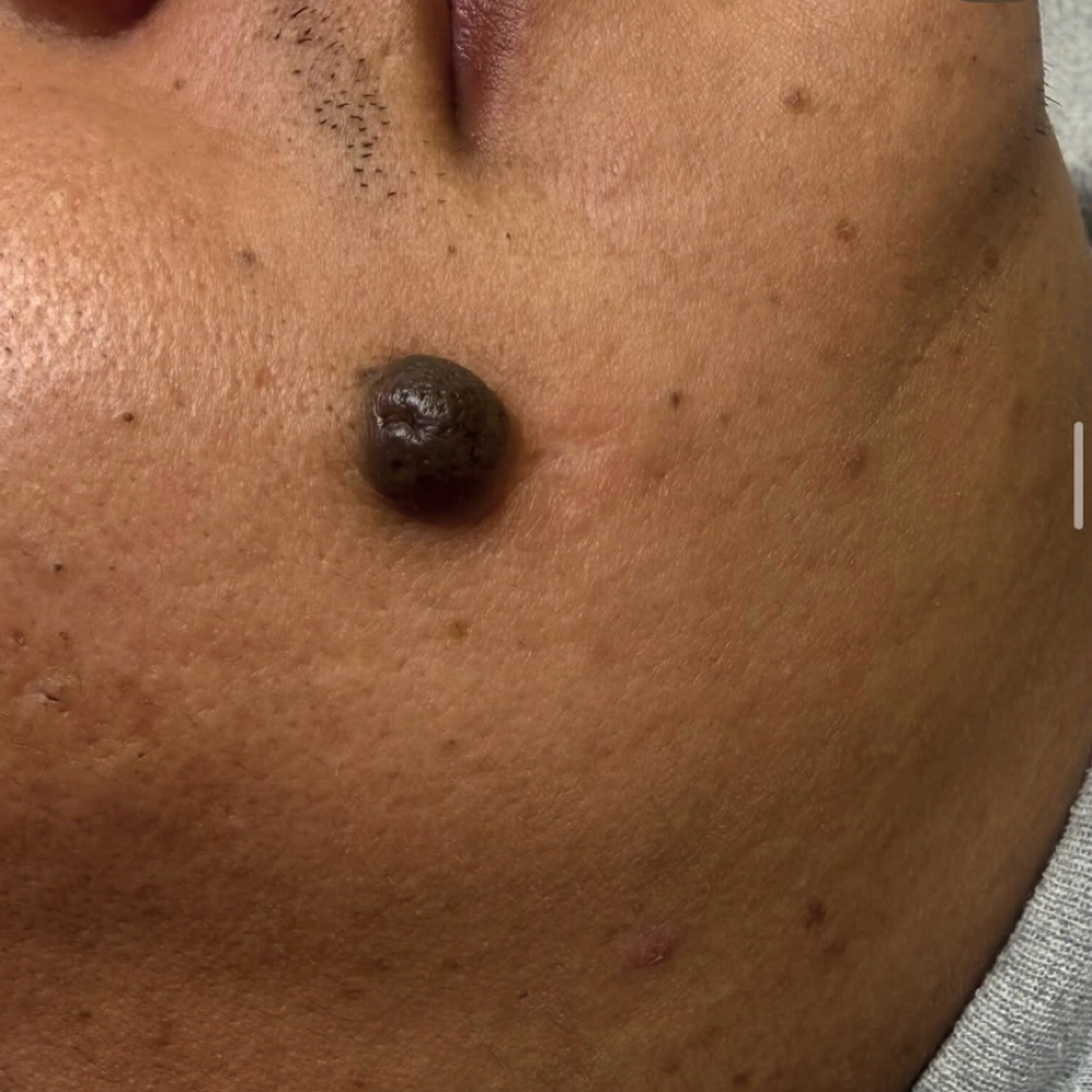 Mole removal at 🎀Pink Diamond Beauty studio🎀 in Irving, TX