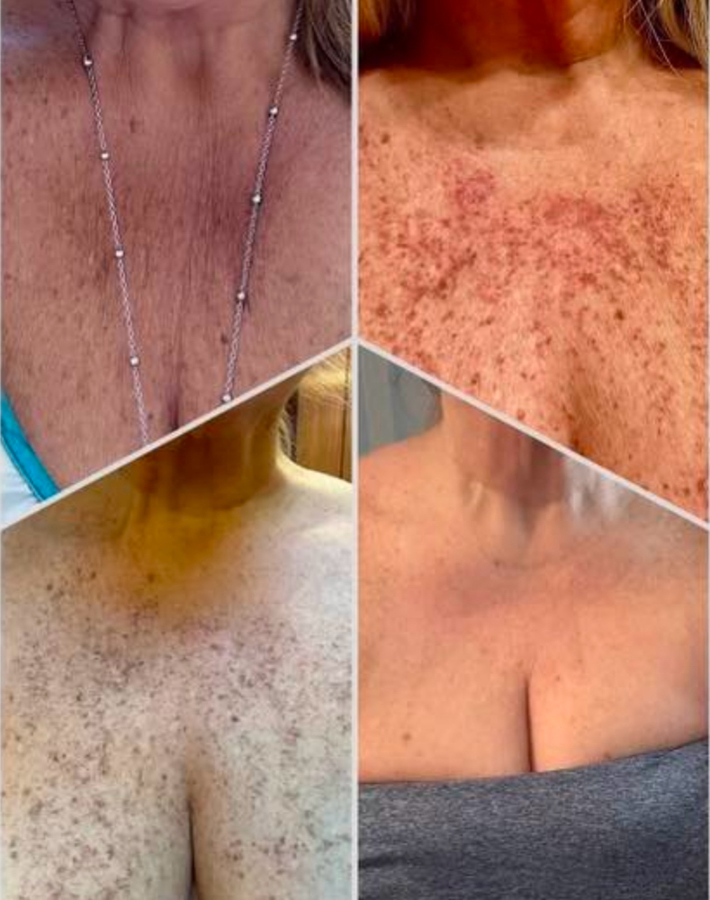 Laser- Body Hyperpigmentation