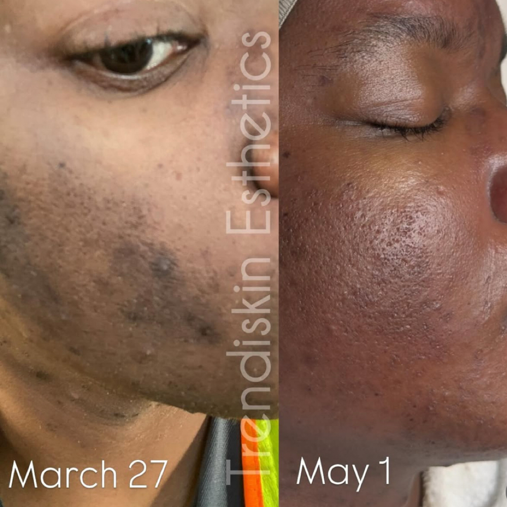 Herbal Peel at Trendiskin Esthetics in Baton Rouge, LA