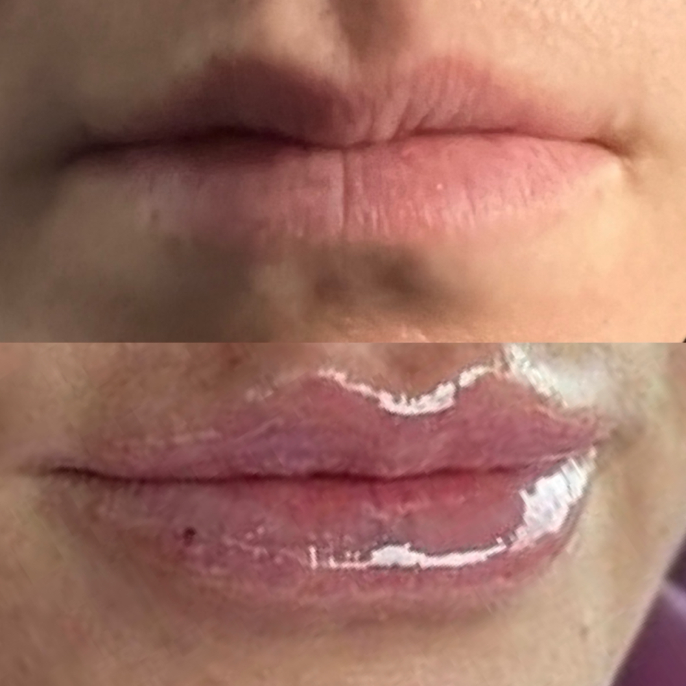 Dermal Filler Training (Lips)