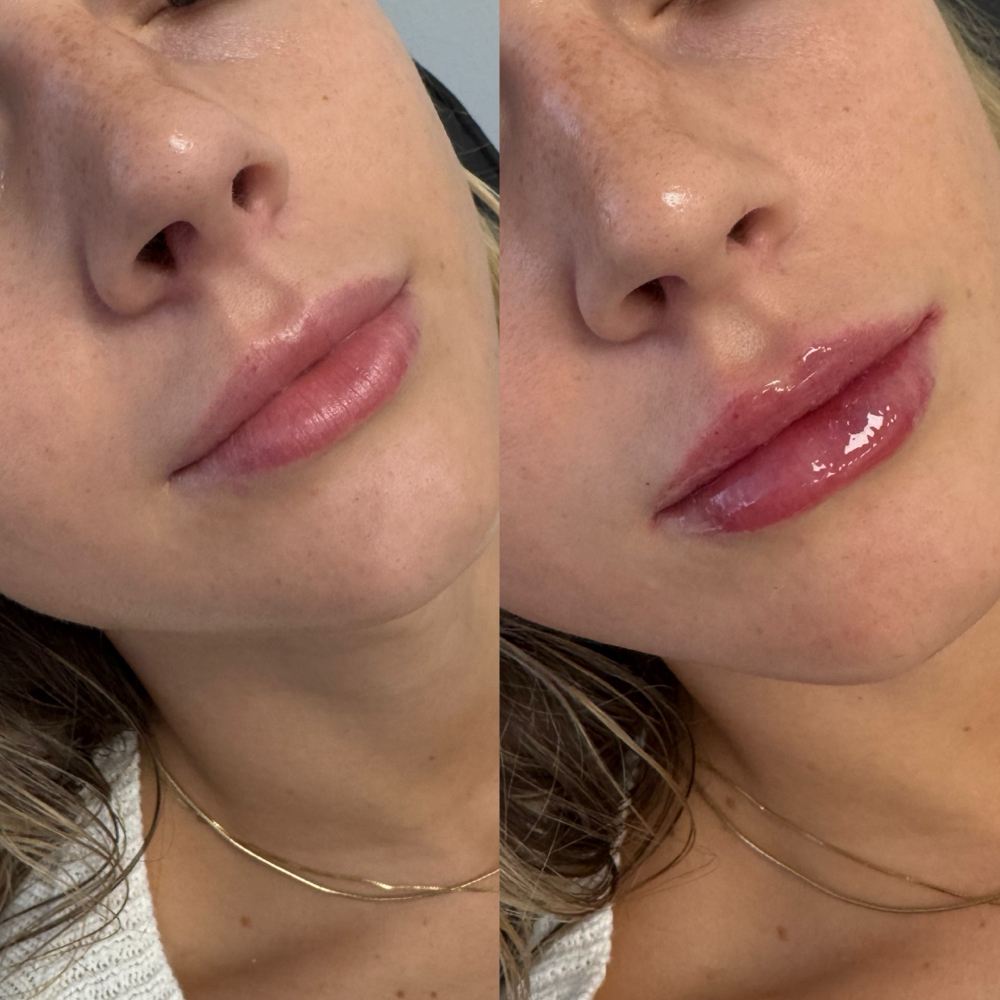 Dermal Filler Training (Lips) at Aesthetic Beauty Bar, LLC By Haley in Tyler, TX