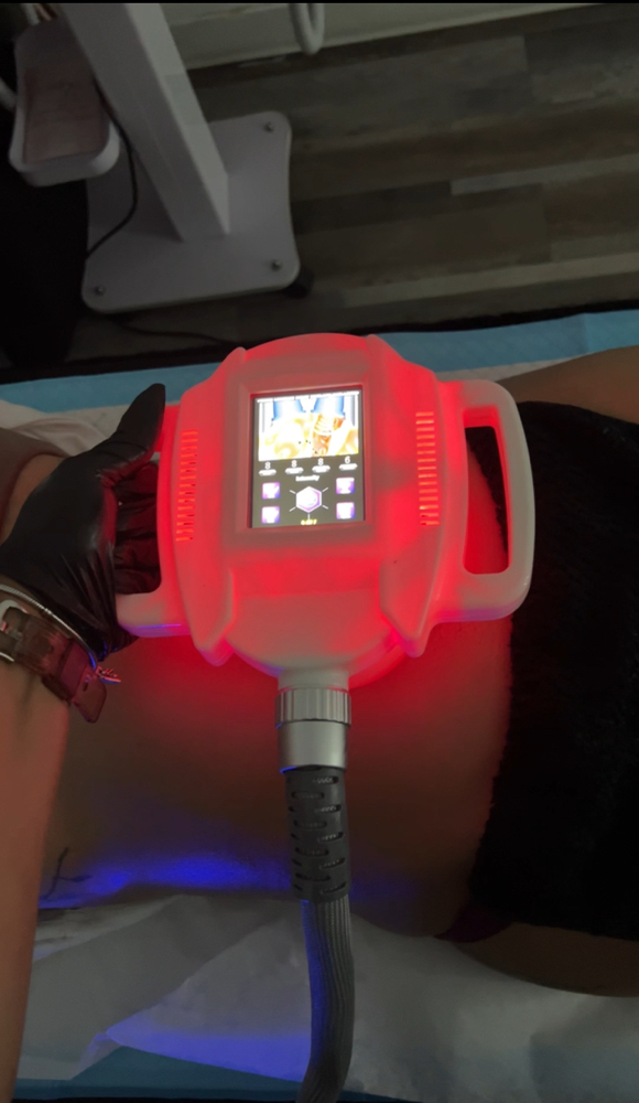 Velashape cellulite reduction