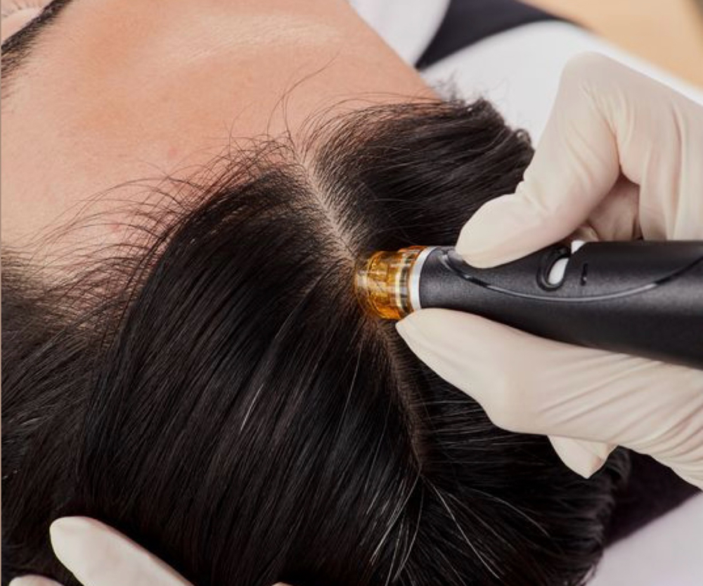 Keravive scalp tretamt