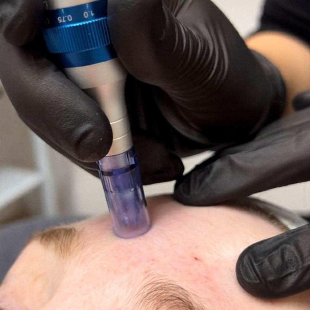 Microneedling With PDRN at Verre Skin in Pembroke Pines, FL
