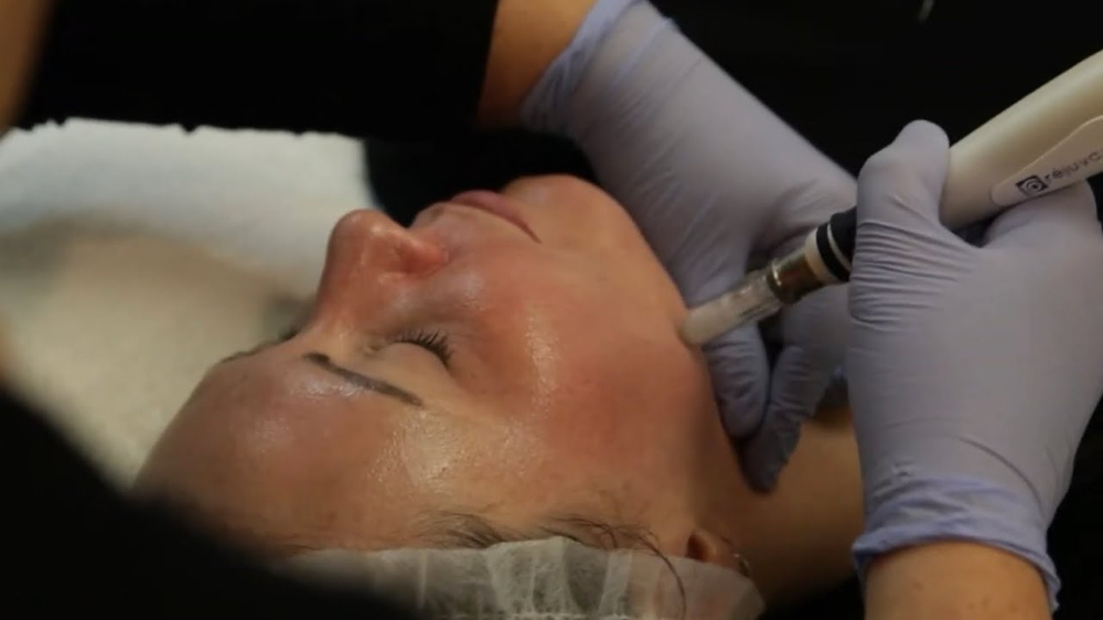 Microdermabrasion Facial