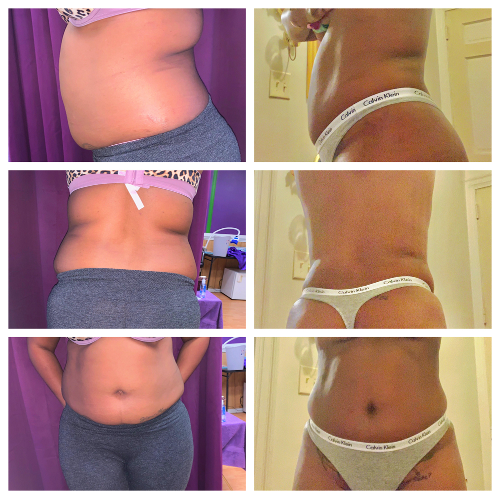 Stomach Injections/Deluxe Butt Injections