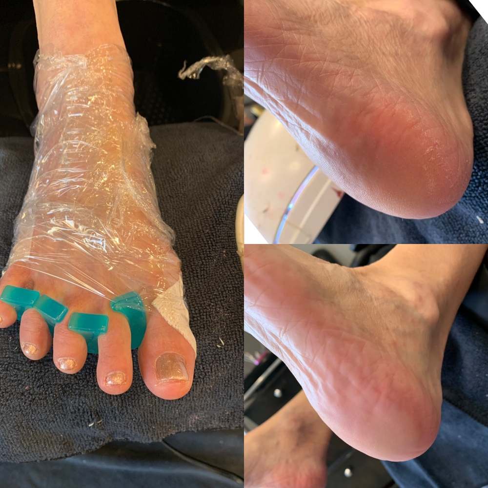 Extreme Callus Treatment-Dry Pedi