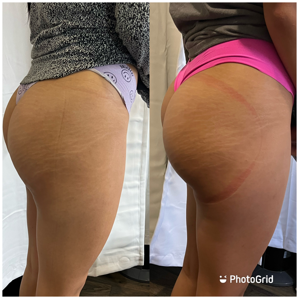 Non-invasive Butt Lift at BeauTIFFul Modifications in Natalia, TX