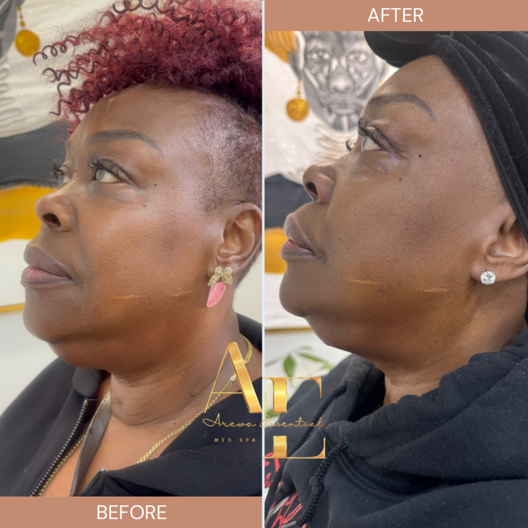 Kybella Chin Sculpting at Arewa Essential Medspa in Mamaroneck, NY