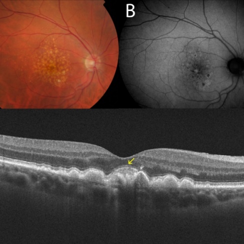 Dry Macular Degeneration Treatment at PRYSM LIGHT in West Burlington, IA