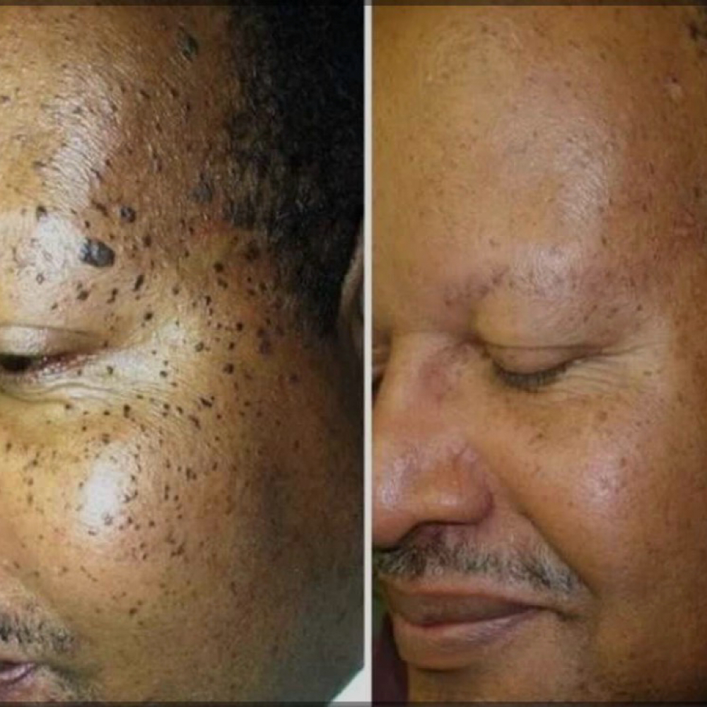 Skintag Mole Removal (Face or Neck) at Spatium Urgent Care & Wellness in Marietta, GA