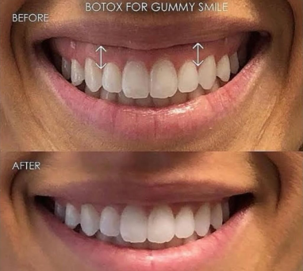 Gummy Smile at Milk & Honey Aesthetics in Sugar Land, TX