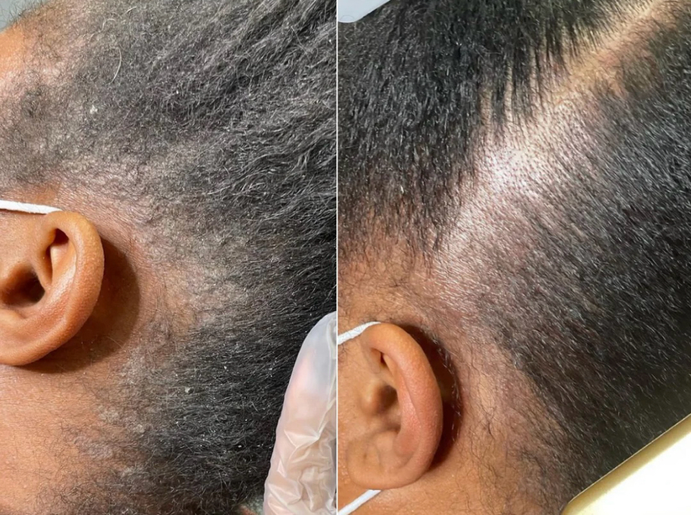 Scalp Exfoliation (ADD-ON)