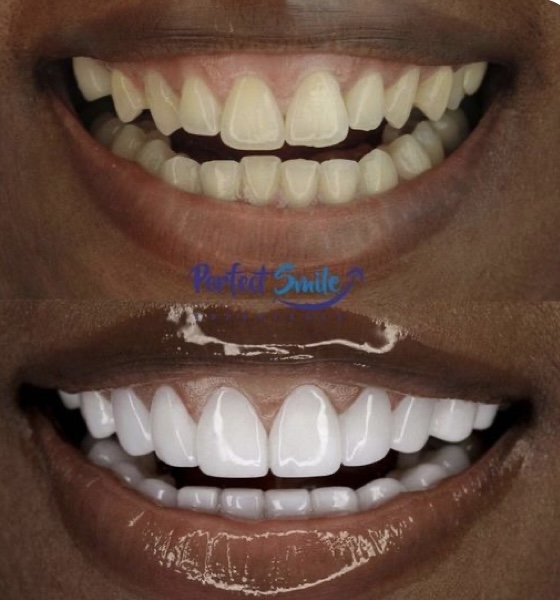 60 Minute Session - Teeth Whitening