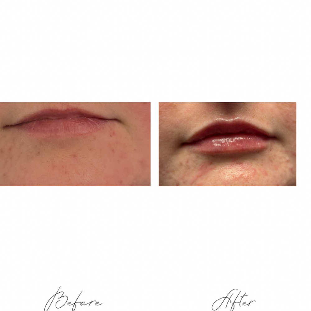 Full Syringe Lip Filler at Davis Wellness & Aesthetics in Cleburne, TX