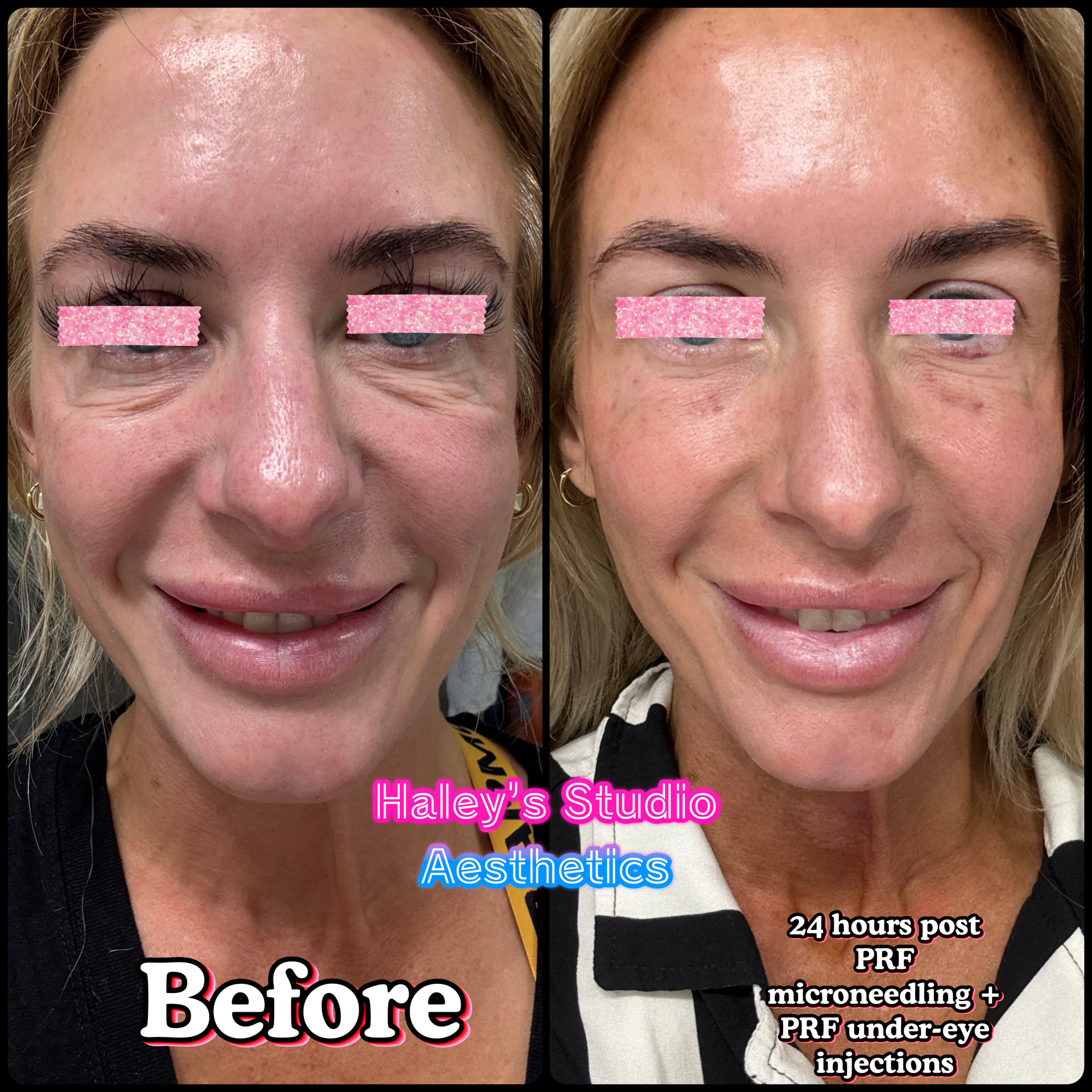 Microneedling