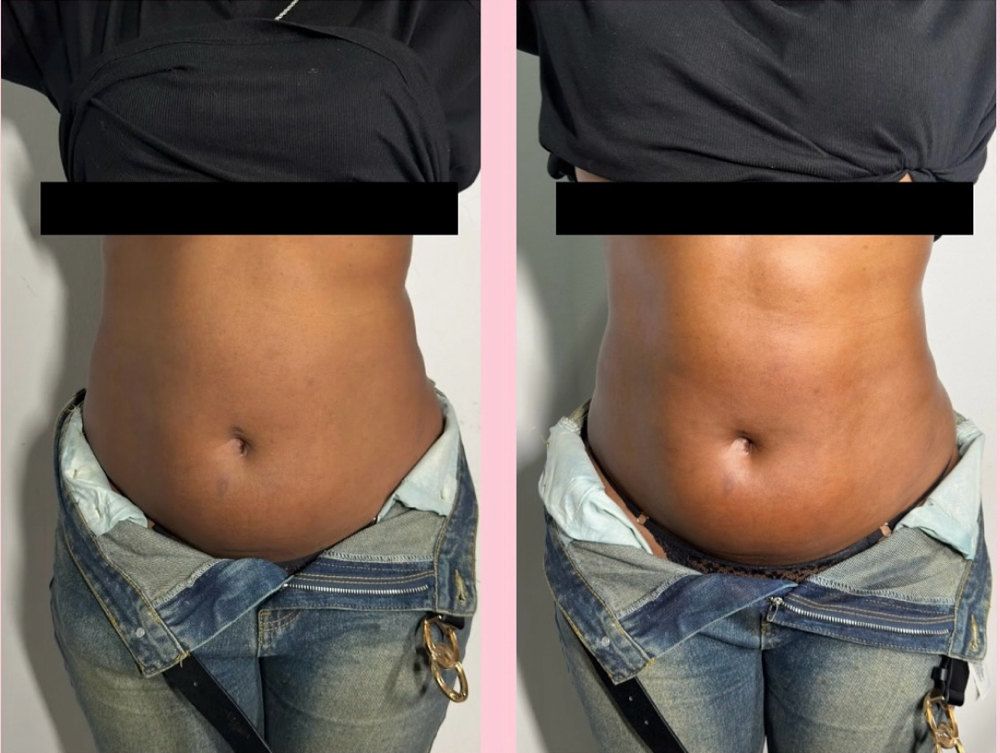 Body Cavitation