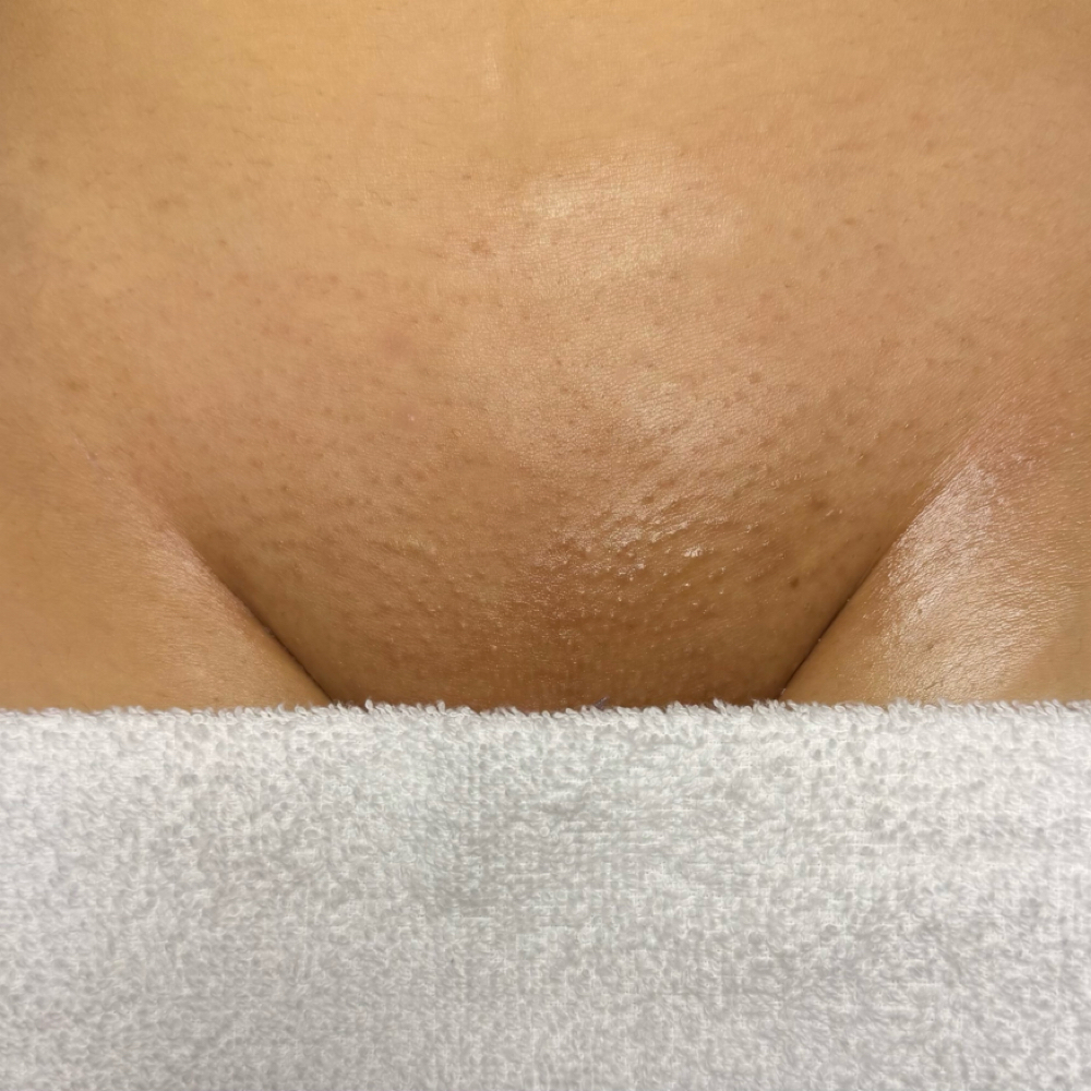 Brazilian at The One Aesthetics in Waco, TX
