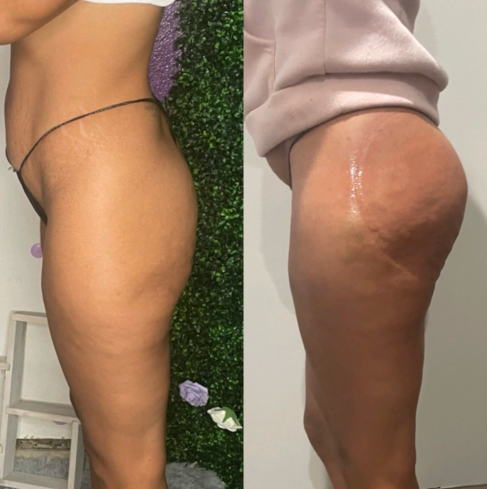 Non-Surgical Bbl 30mins