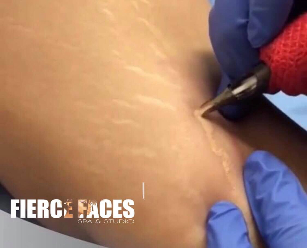 Stretch Marks Camouflage Tattoo