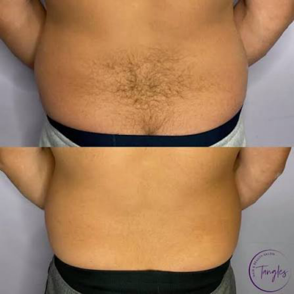 Lower Back Laser - 5 Sessions at Blessed & Bare Laser Studio in New York, NY