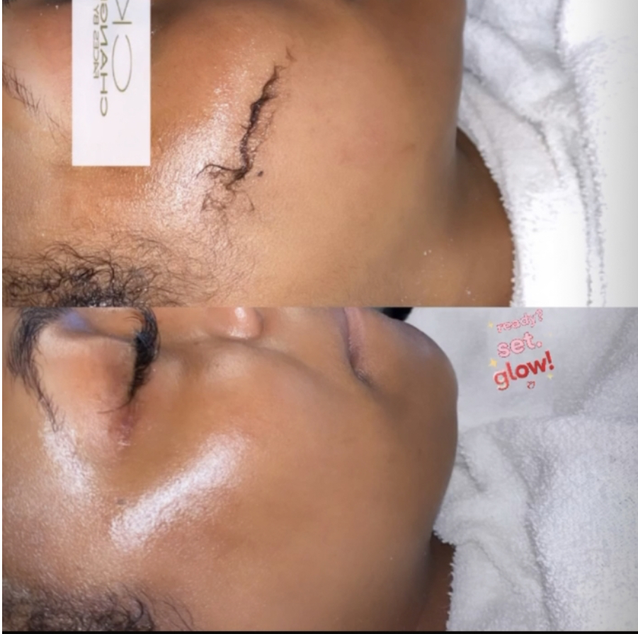 Dermaplaning Facial