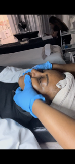 Hyperpigmentation Facial