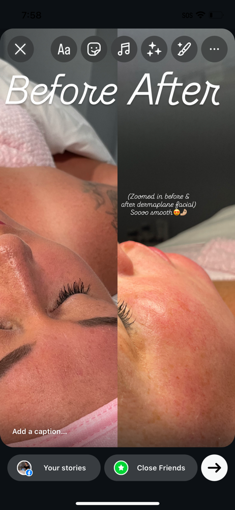 Dermaplane Add-On