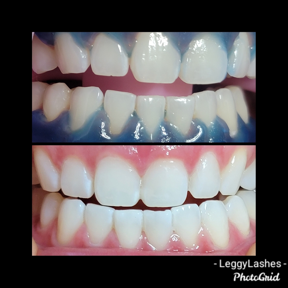 90 Minute Zoom Teeth Whitening