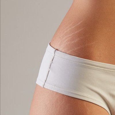 STRETCHMARKS FLANKS at Deesignz Lash & Brow Studio in Lagrange Park, IL
