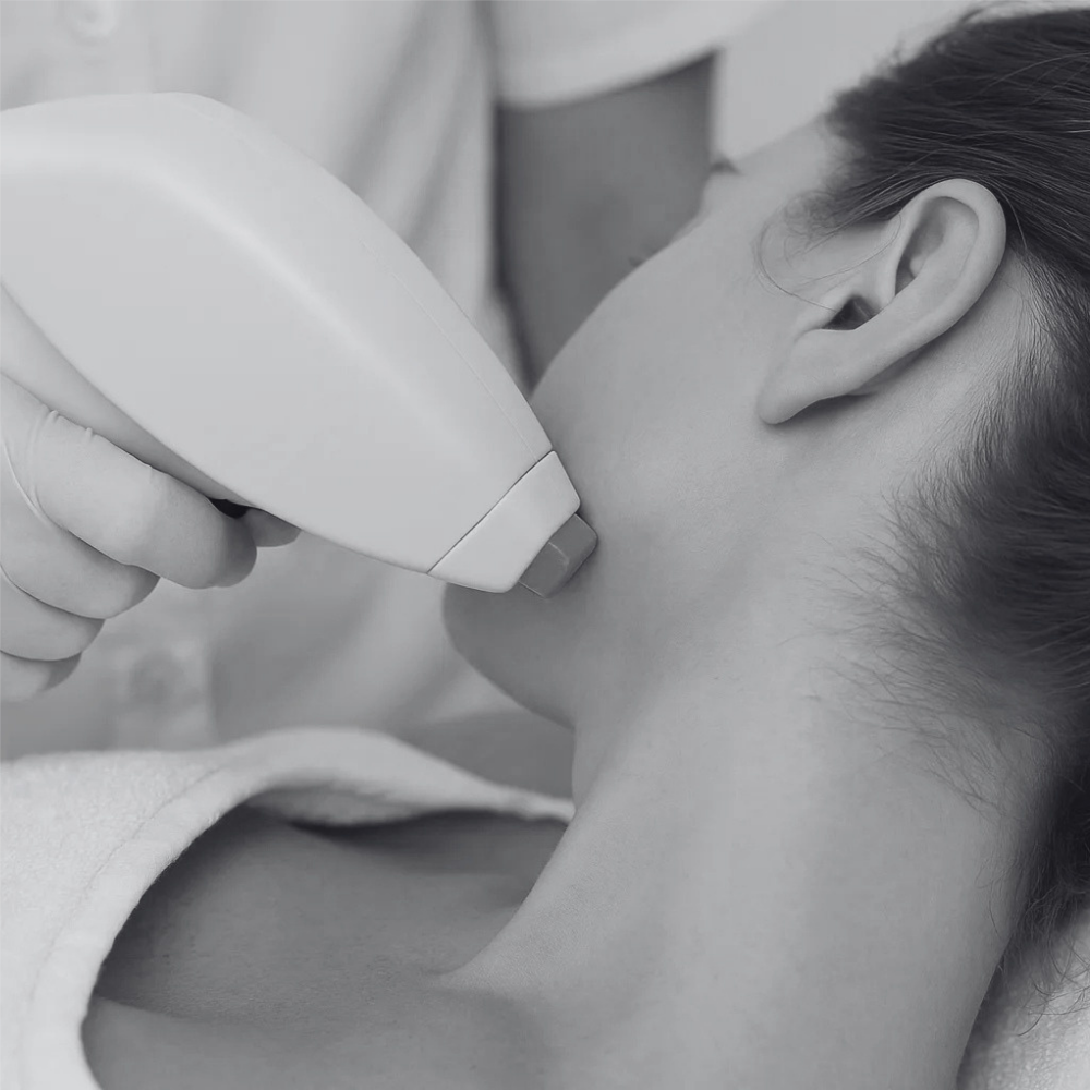 Laser Hair Removal - Chin at Kietre Wellness & Aesthetics in North Las Vegas, NV