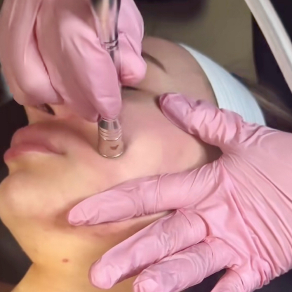 Micro-Dermabrasion Facial