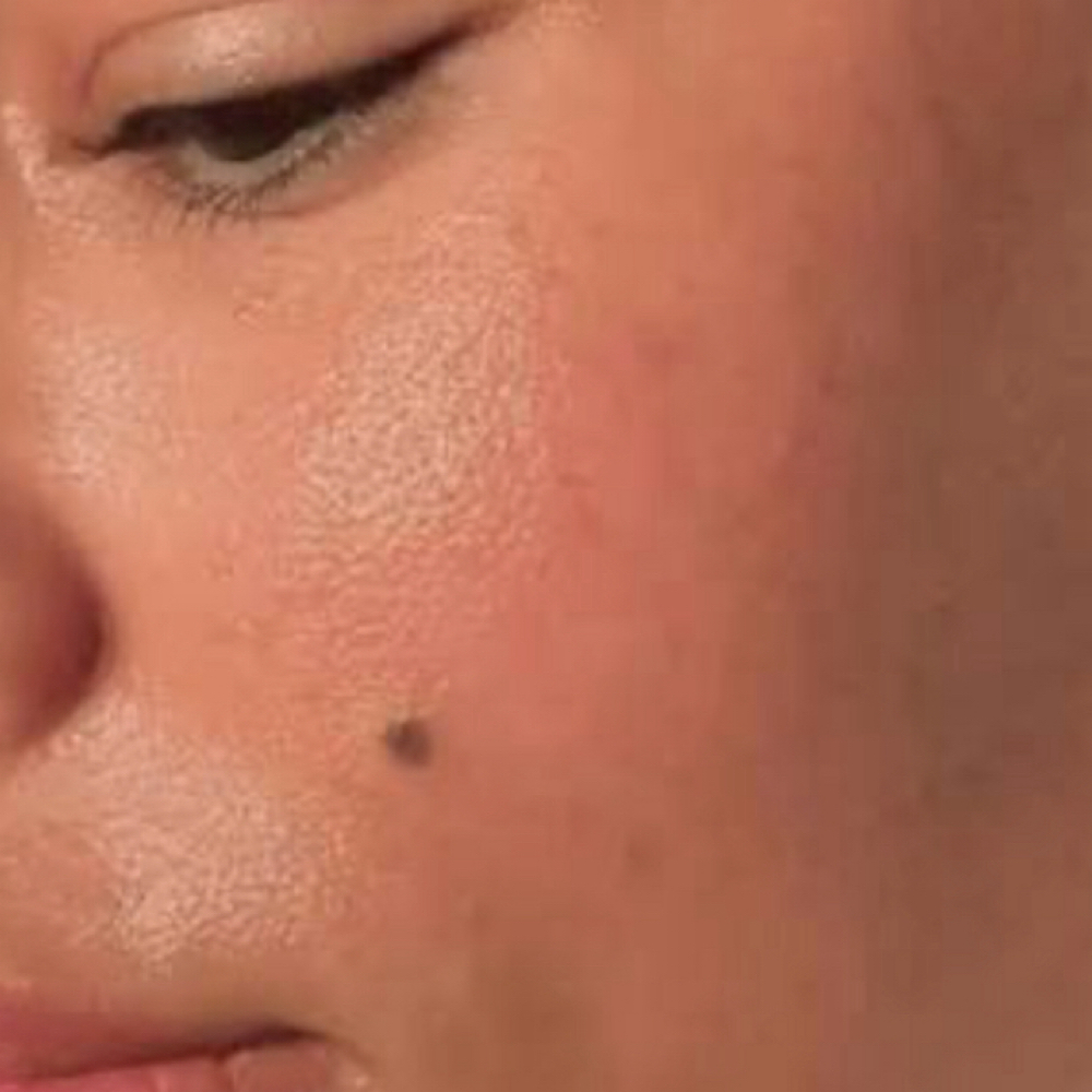 Dermaplaning at La Belle Fleur in Highland, IN