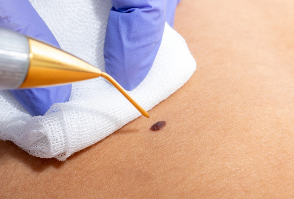 Skin Tag Removal