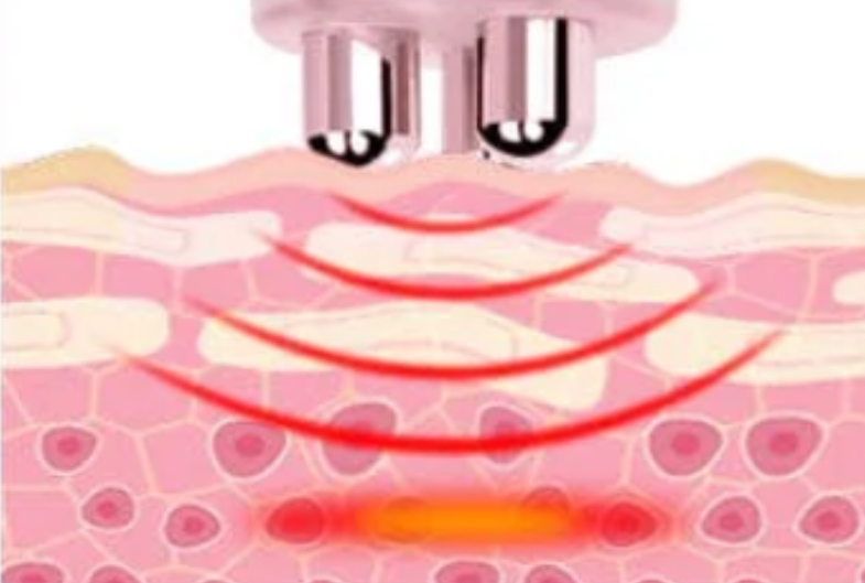 Radio Frequency Facial