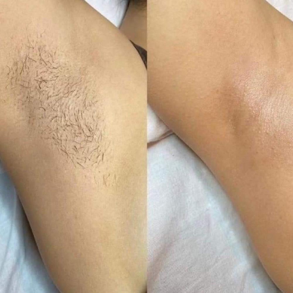 Underarms Wax at LauLux Esthetics in Bellerose, NY