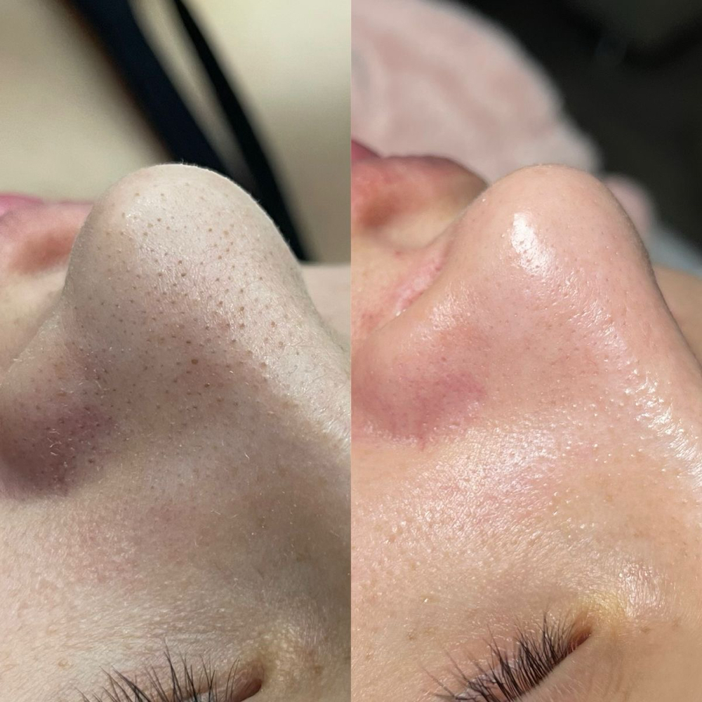 BLACKHEAD REMOVAL
