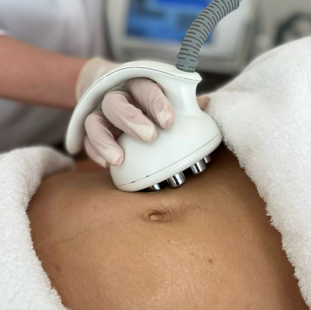Venus Legacy -Body Contouring at Vanessa Yarce in Miami, FL