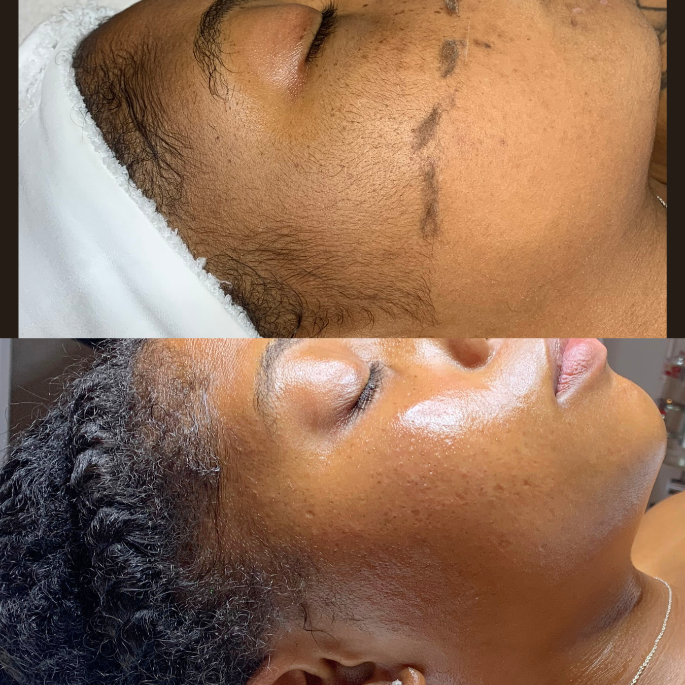 Dermaplaning Facial
