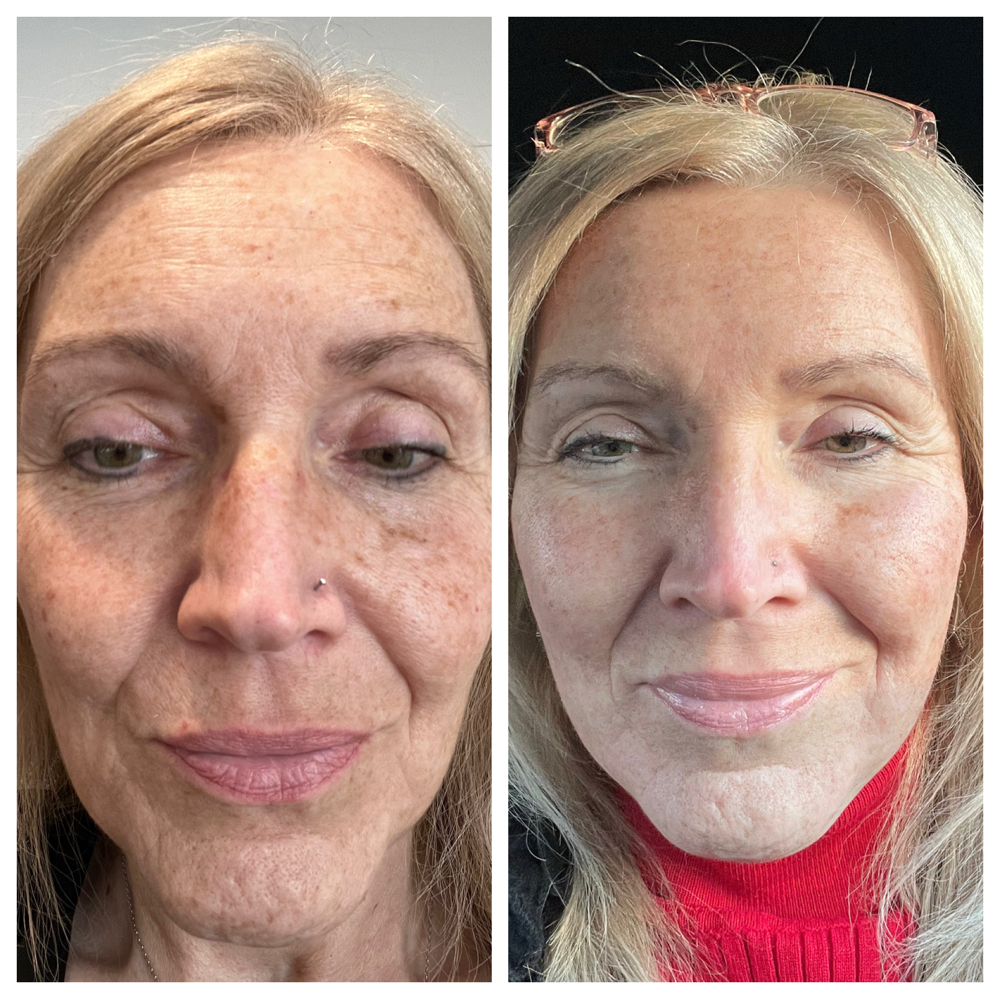 Single- Skin Resurfacing Laser