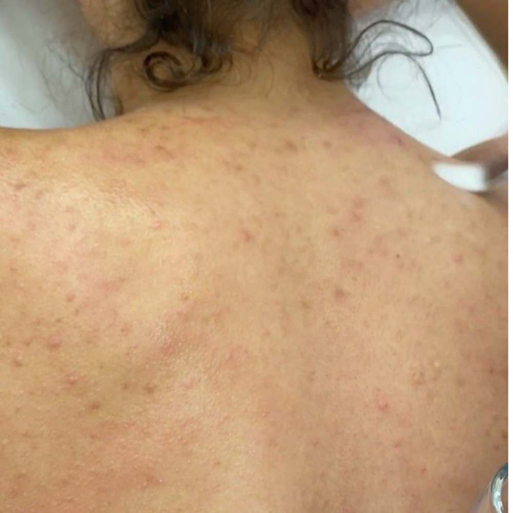 Back Detox Skin Treatment at Skincare By Liliya in Sherman Oaks, CA